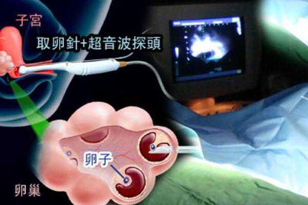 北京什么医院有做供卵手术,影响北京供卵医院做三代试管费用的因素,2023北京没
