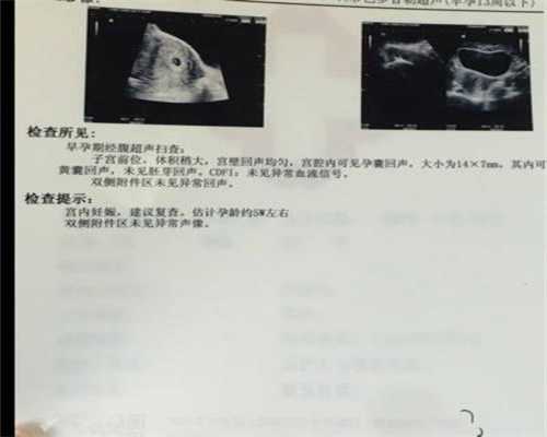 供卵多少钱北京金贝_西囡医院供卵成功率_抗卵巢抗体会导致不孕吗